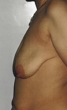 Podniesienie piersi – przed